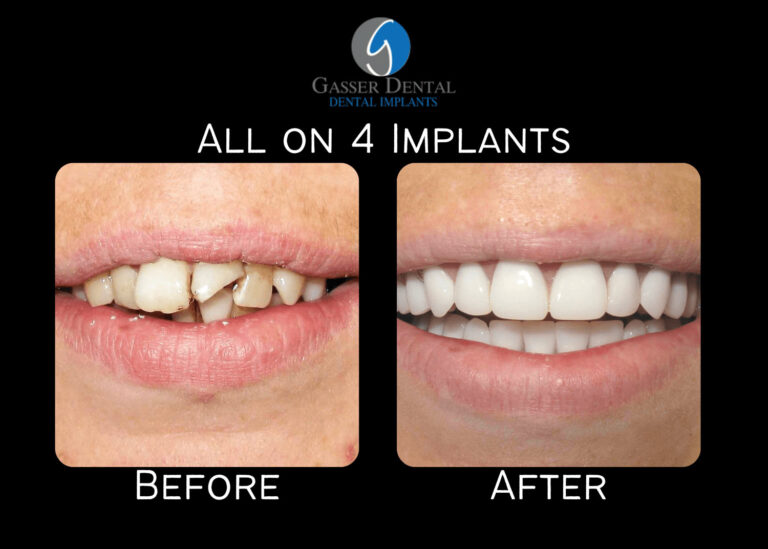 all on 4 implants before and after