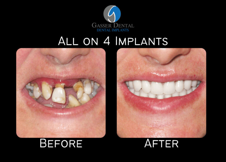 all on 4 implants before and after