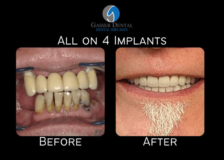 all on 4 implants before and after