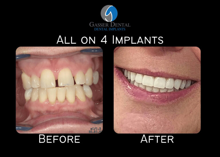 all on 4 implants before and after
