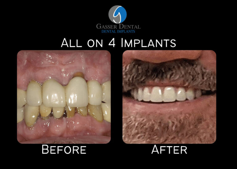 all on 4 implants before and after