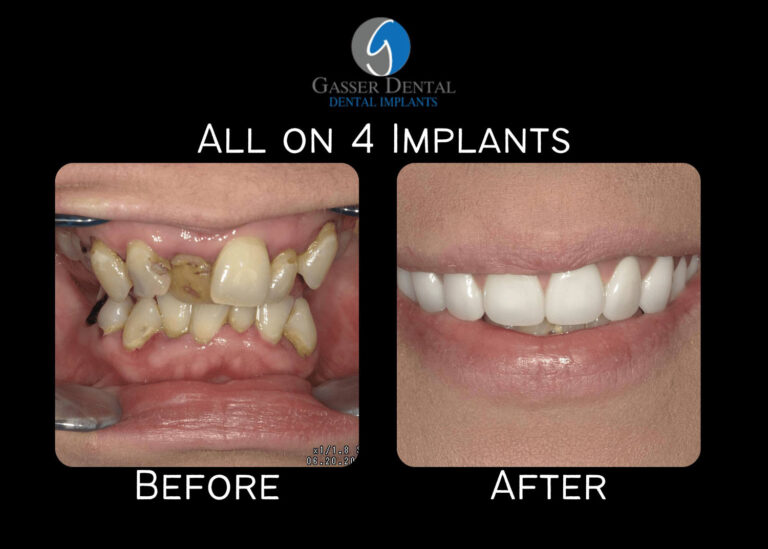 all on 4 implants before and after