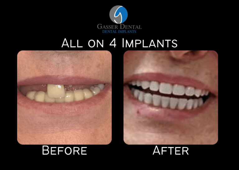 all on 4 implants before and after