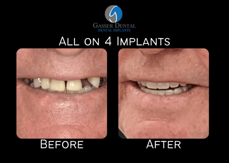 all on 4 implants before and after