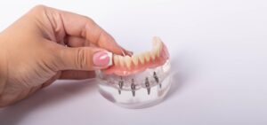 render of mandibular prosthesis all on 4 system supported by implants