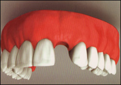 Single Tooth Implant