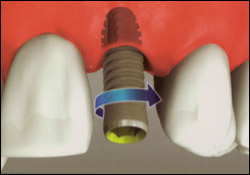 Single Tooth1