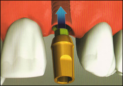 Single Tooth2