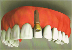 Single Tooth3