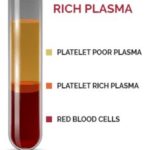 platelet-rich-plasma-diagr-upd