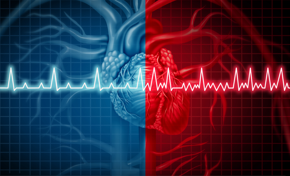 Atrial fibrillation and normal or abnormal heart rate rythm as a cardiac disorder