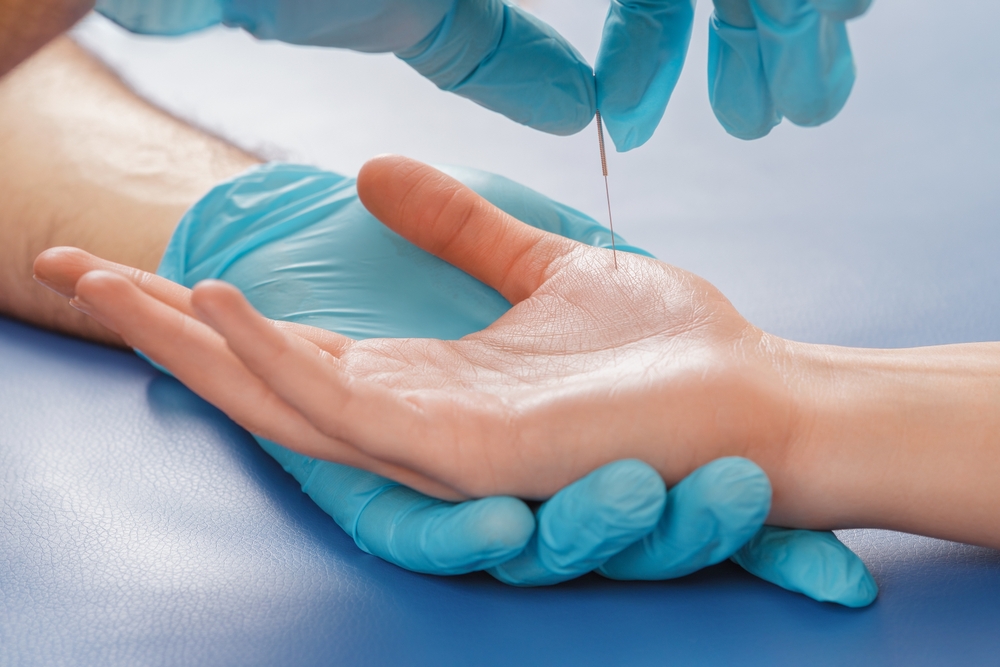 Acupuncture treatment on a patient's hand