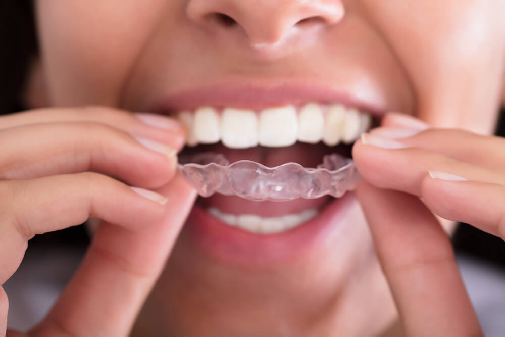 Woman's Hand Putting Transparent Aligner In Teeth