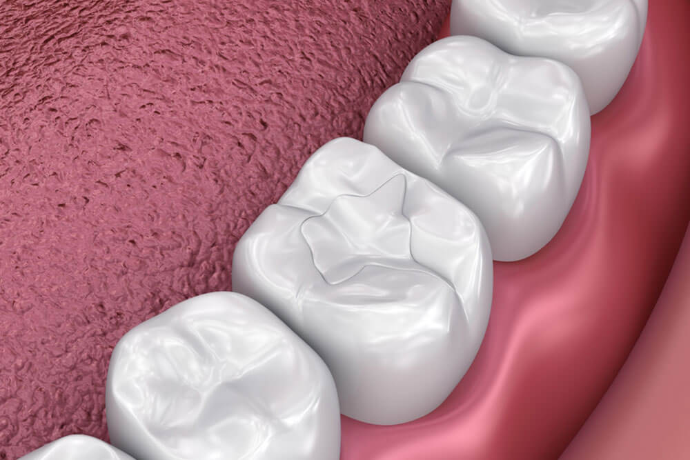 dental fillings in a human mouth