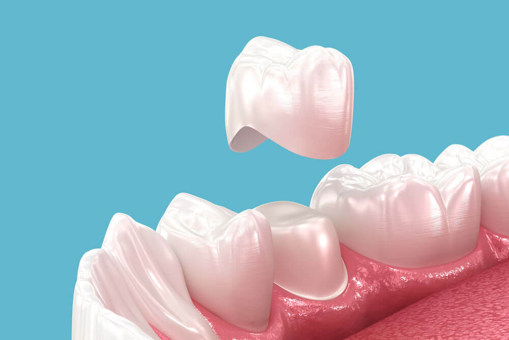 Dental crown placement over tooth