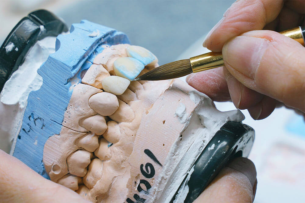 dental technician working on a dental prosthesis, likely applying or shaping a material on a model of teeth