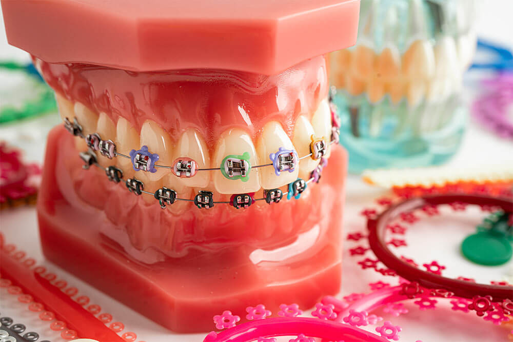 Orthodontic ligatures, rings, and ties (elastic rubber bands)