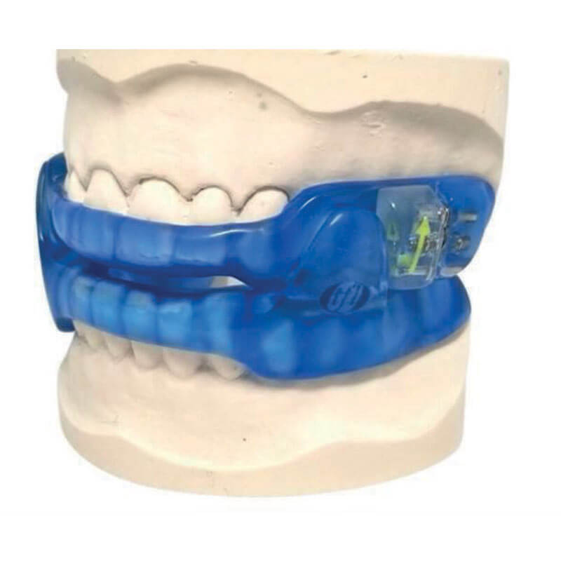 Mandibular Advancement Device (MAD)