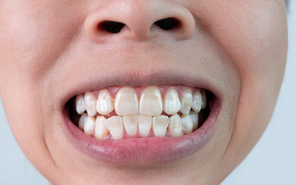 White Spot Lesions