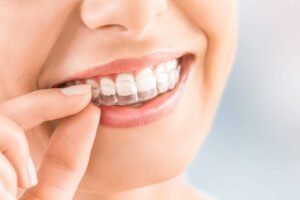 Invisalign®