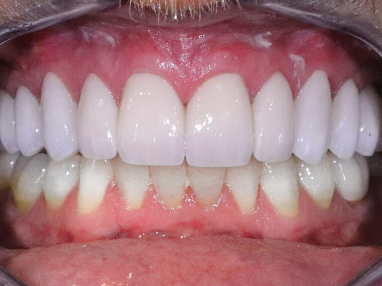 Full Mouth Reconstructions after