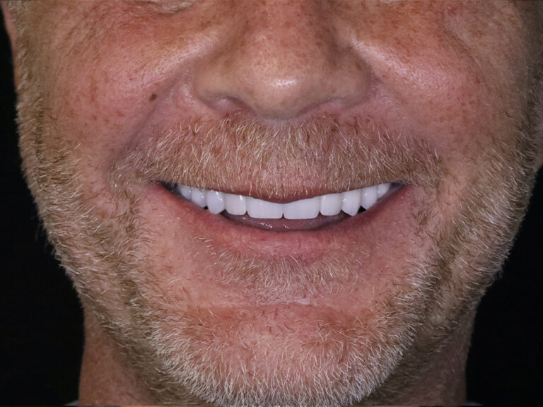 Full Mouth Reconstructions after