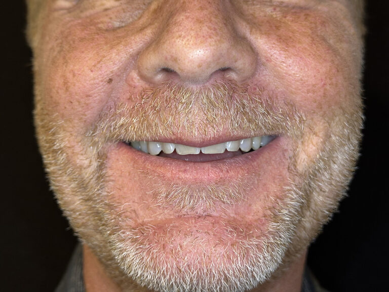 Full Mouth Reconstructions before