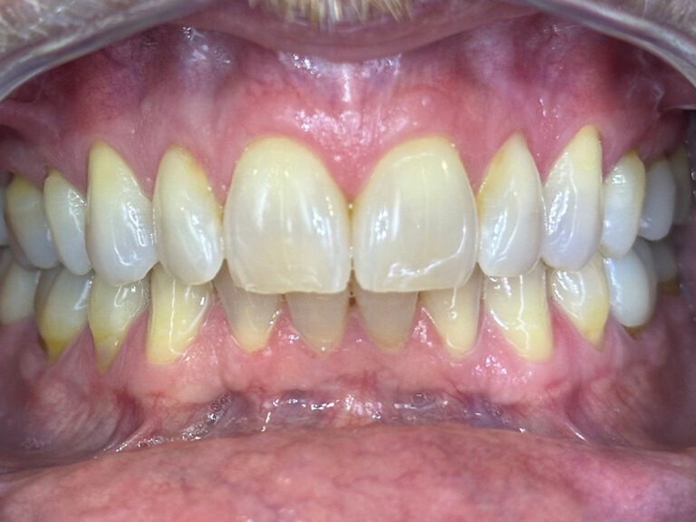 Full Mouth Reconstructions before