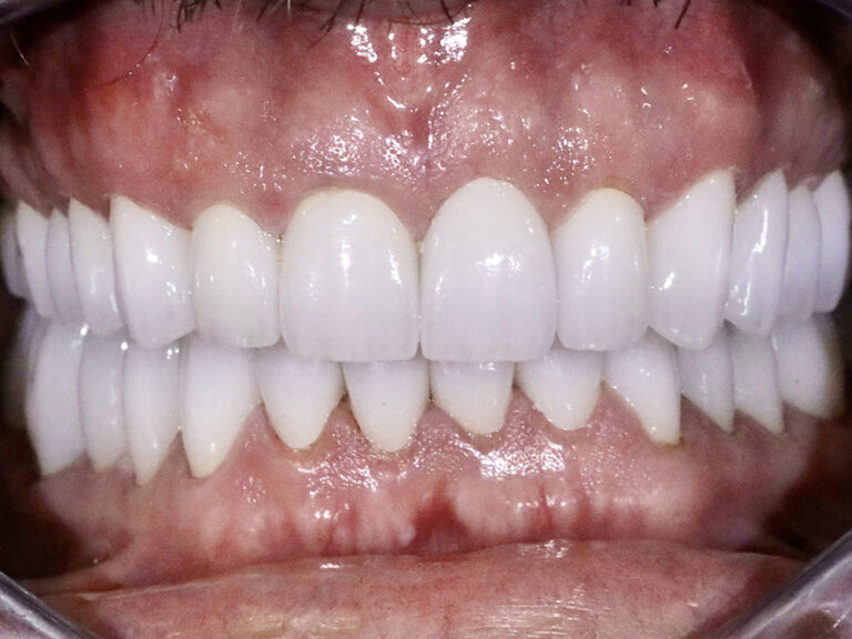 Full Mouth Reconstructions after
