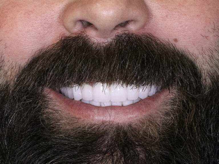 Full Mouth Reconstructions after