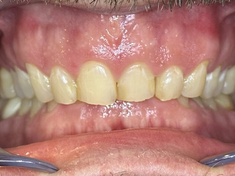 Full Mouth Reconstructions before