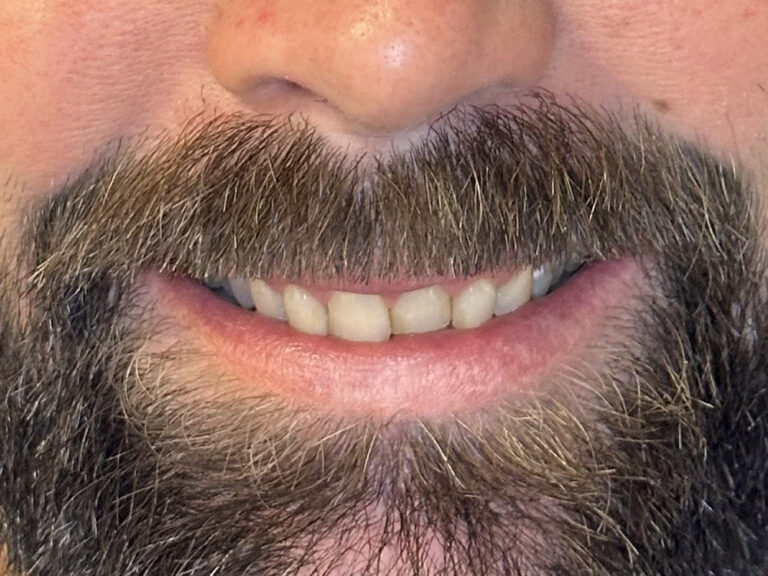 Full Mouth Reconstructions before