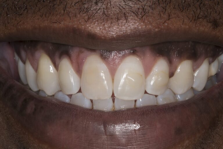 Guy1smileBefore-scaled