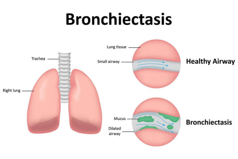 Bronchiectasis Labeled Diagram