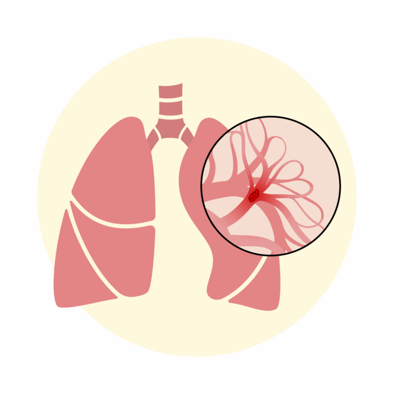 illustration - pulmonary embolism care