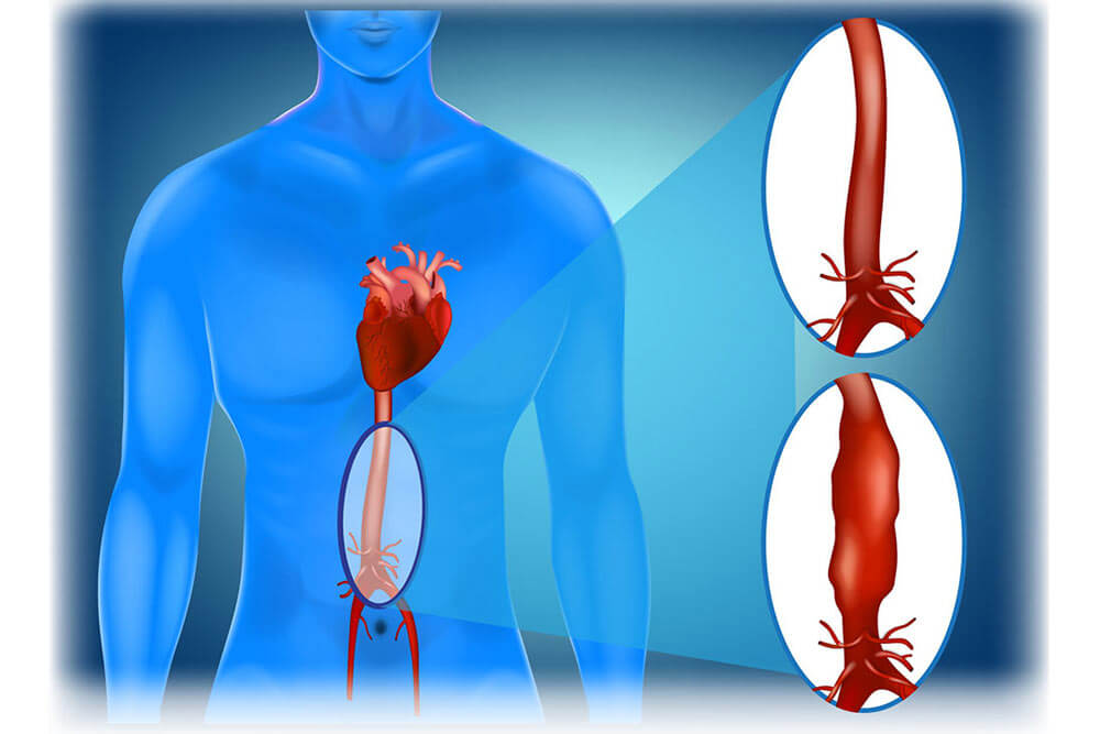 Aneurysmal Disease