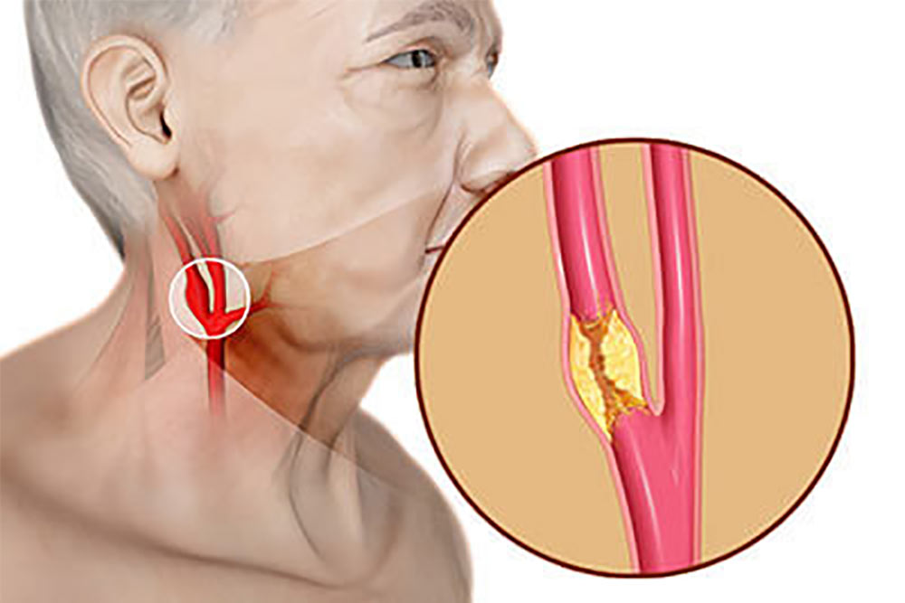 Carotid Artery Disease