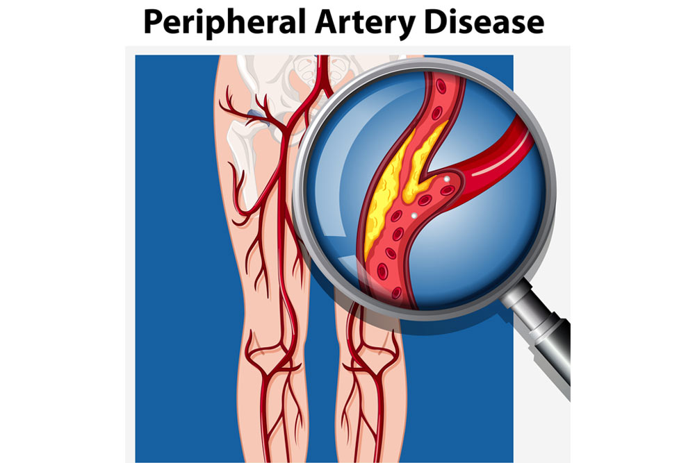 Peripheral Artery Disease