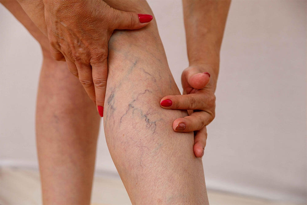 Varicose Veins