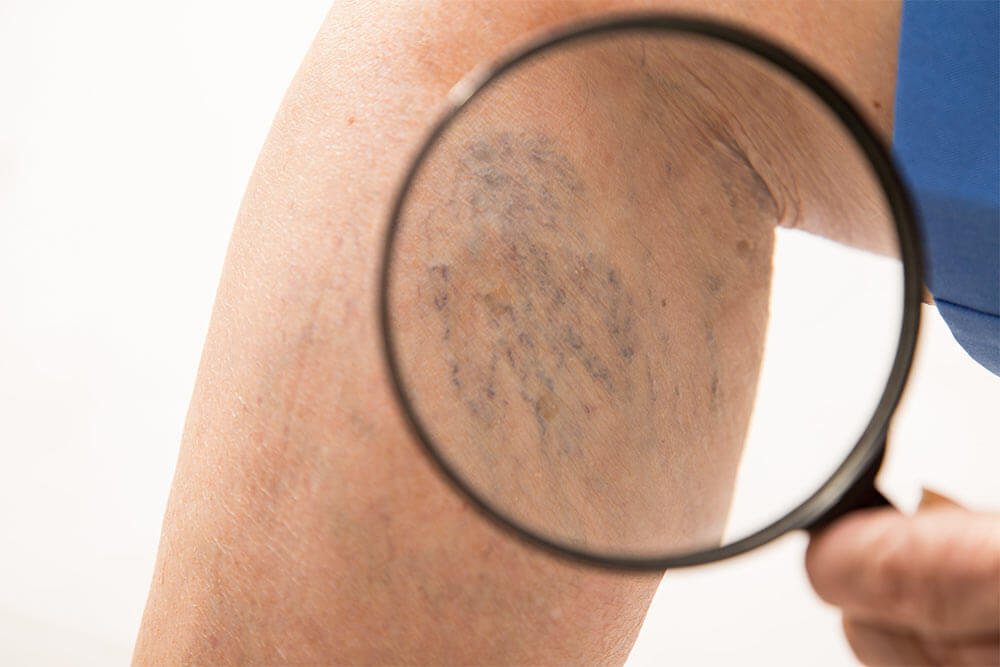 Venous Disease