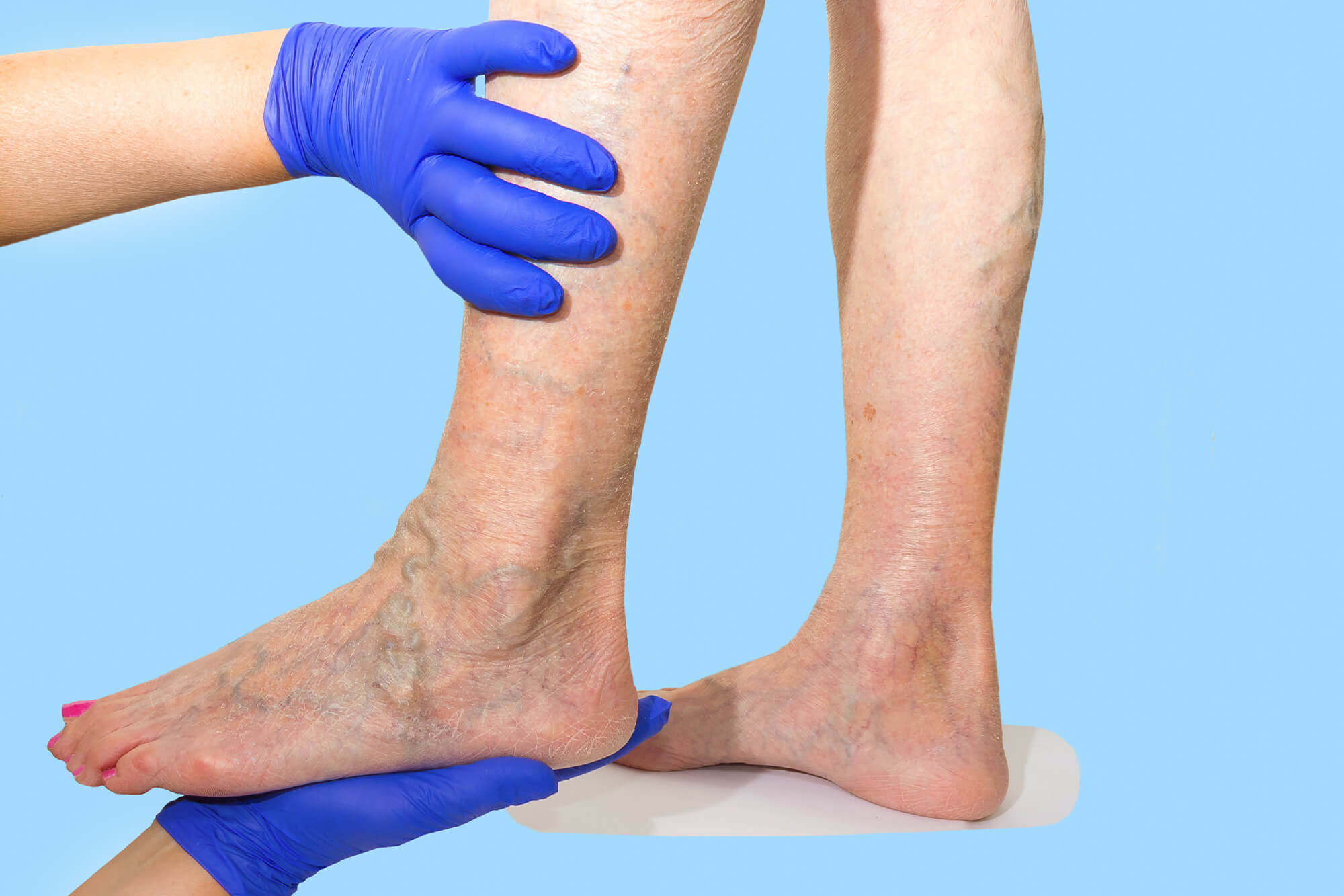 Chronic Venous Insufficiency (CVI) Treatment