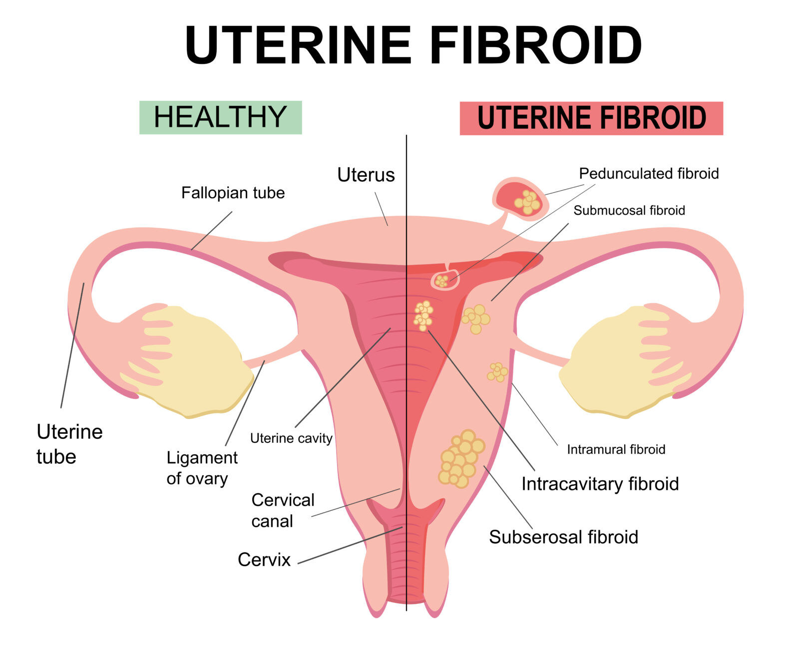 Uterine Fibroid Embolization (UFE) Treatment | Premier Vascular