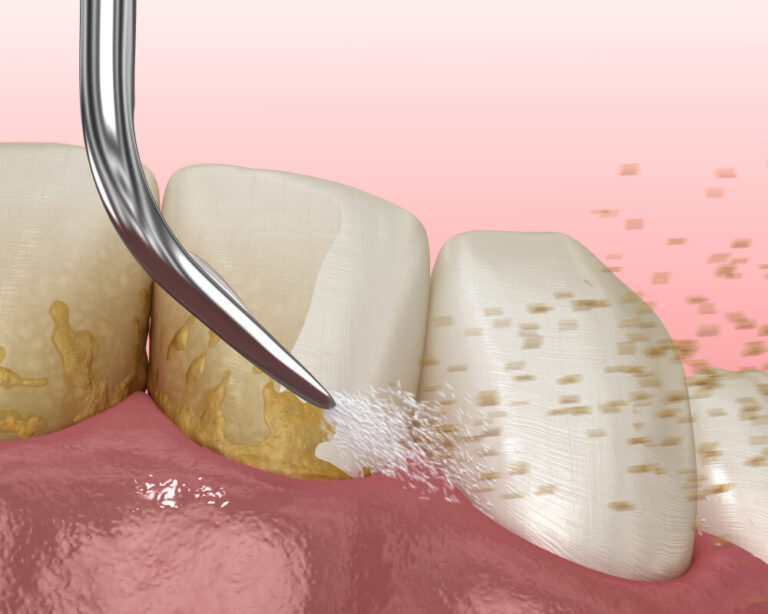 Oral hygiene: Scaling and root planing (conventional periodontal therapy