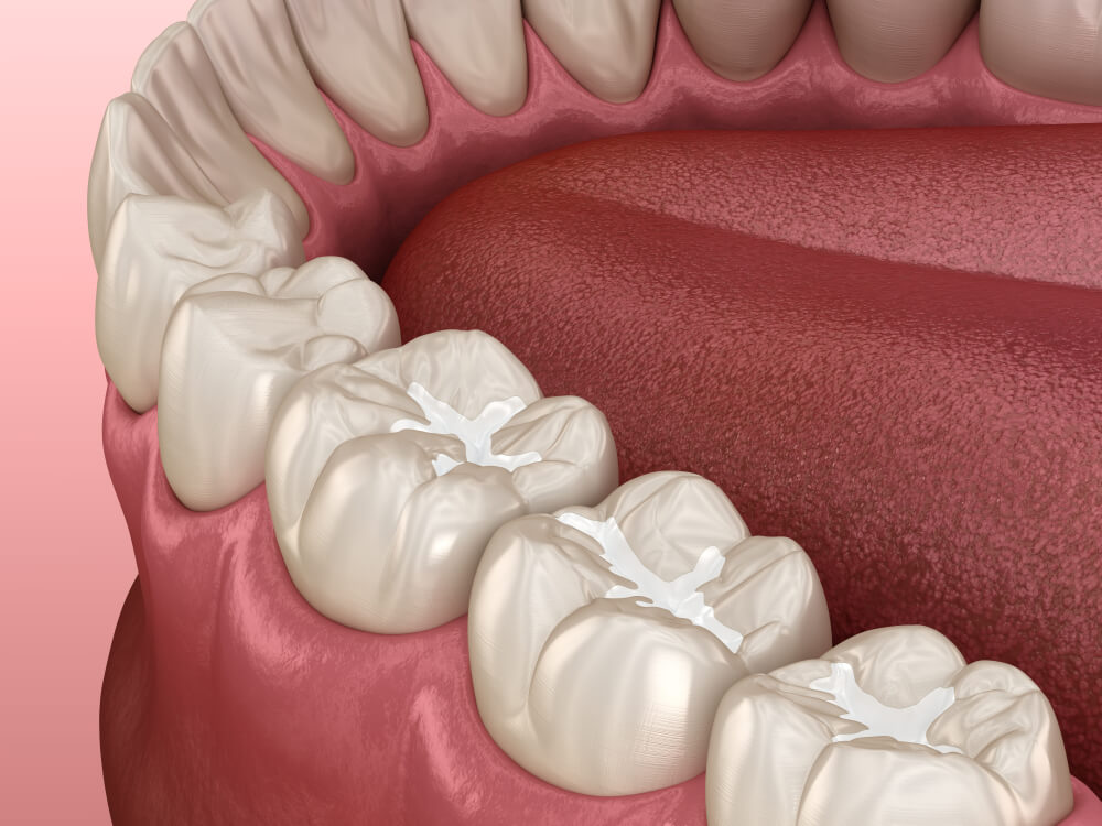 Molar Fissure dental fillings, Medically accurate 3D illustration