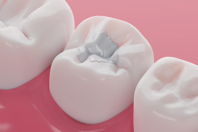Teeth white composite filling, Decay and broken teeth treatment concept