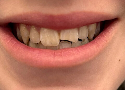 Tooth fractured from injury