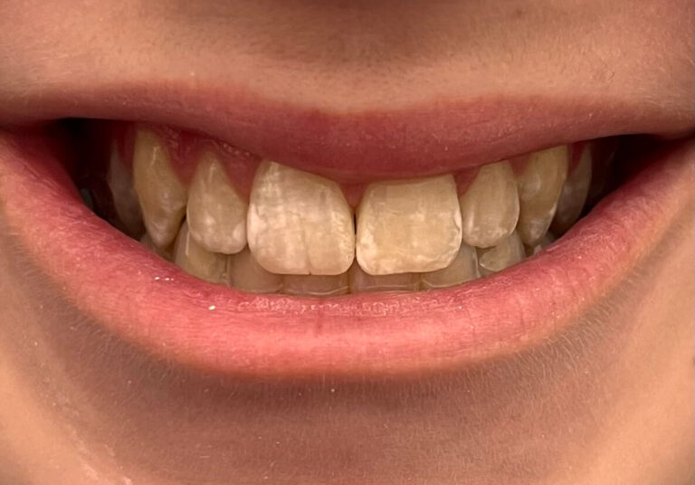 Tooth Repaired to look and function naturally