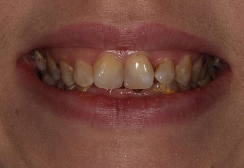 Full Mouth Rehab before