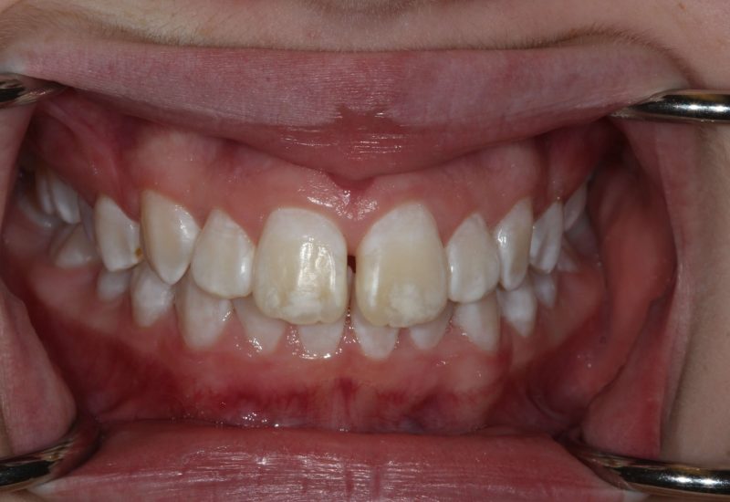 Microabrasion after