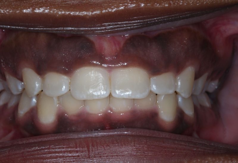Gingivectomy before